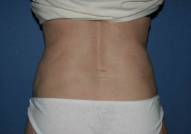 Power Assisted Liposuction Before & After Patient #1088