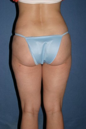 Power Assisted Liposuction Before & After Patient #1109