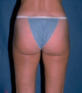 Power Assisted Liposuction Before & After Patient #1119