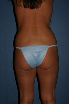 Power Assisted Liposuction Before & After Patient #1124
