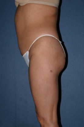 Power Assisted Liposuction Before & After Patient #1096