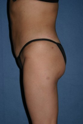 Power Assisted Liposuction Before & After Patient #1096