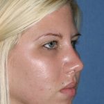 Rhinoplasty Before & After Patient #811