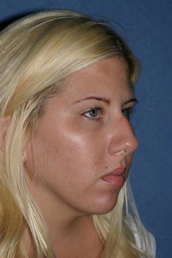 Rhinoplasty Before & After Patient #811