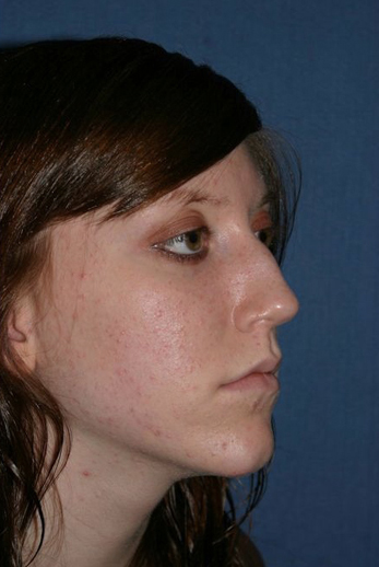 Rhinoplasty Before & After Patient #821