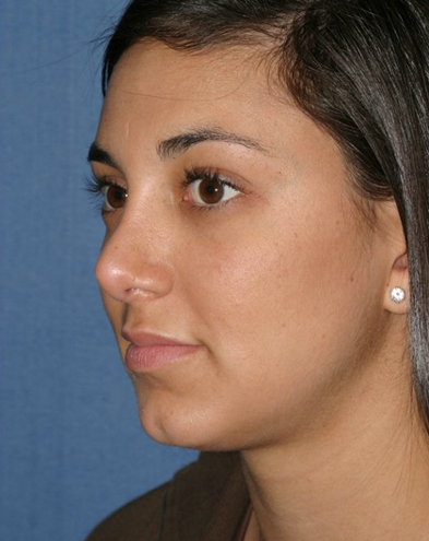 Rhinoplasty Before & After Patient #835