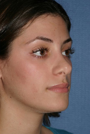 Rhinoplasty Before & After Patient #749