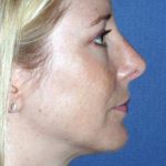 Rhinoplasty Before & After Patient #786