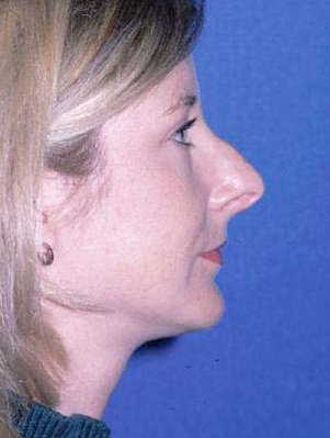Rhinoplasty Before & After Patient #786