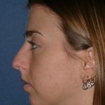 Rhinoplasty Before & After Patient #789