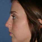 Rhinoplasty Before & After Patient #789
