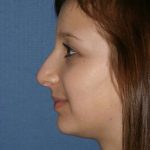 Rhinoplasty Before & After Patient #806