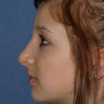 Rhinoplasty Before & After Patient #806