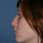 Rhinoplasty Before & After Patient #821