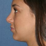 Rhinoplasty Before & After Patient #835