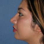 Rhinoplasty Before & After Patient #742