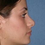 Rhinoplasty Before & After Patient #749