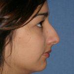 Rhinoplasty Before & After Patient #756