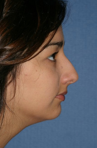 Rhinoplasty Before & After Patient #756