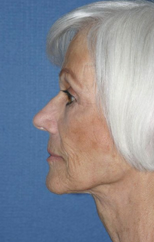 Rhinoplasty Before & After Patient #761