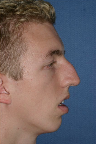 Rhinoplasty Before & After Patient #773