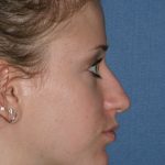 Rhinoplasty Before & After Patient #778