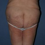 Body Lift Before & After Patient #874