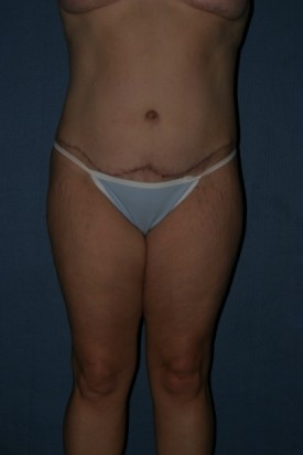 Body Lift Before & After Patient #893