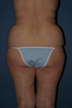 Body Lift Before & After Patient #914