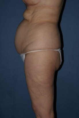 Body Lift Before & After Patient #914