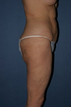 Body Lift Before & After Patient #902