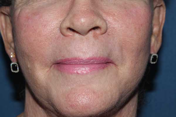 Croton Peel Before & After Patient #1509