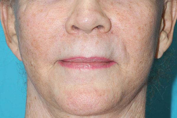 Croton Peel Before & After Patient #1509