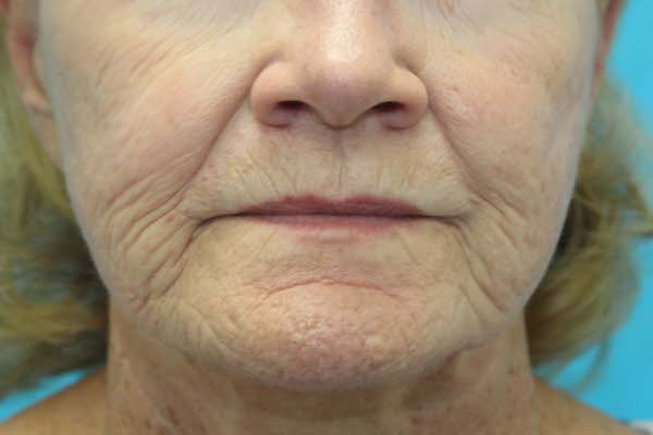 Croton Peel Before & After Patient #1523