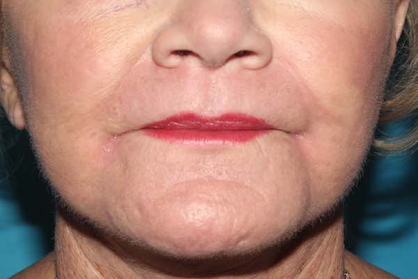 Croton Peel Before & After Patient #1523