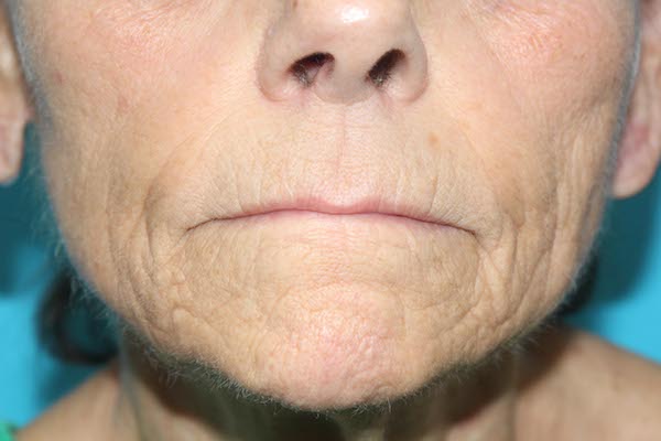 Croton Peel Before & After Patient #1531