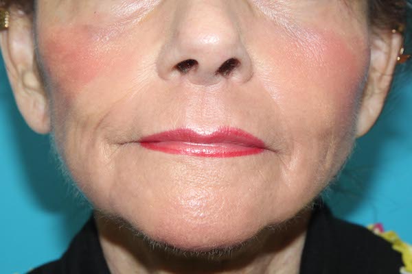 Croton Peel Before & After Patient #1531