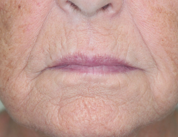 Croton Peel Before & After Patient #1536