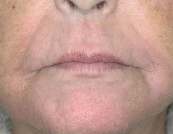 Croton Peel Before & After Patient #1536