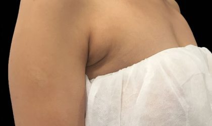 CoolSculpting Before & After Patient #1470