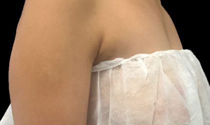 CoolSculpting Before & After Patient #1470