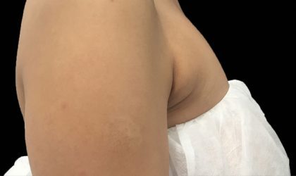CoolSculpting Before & After Patient #1470