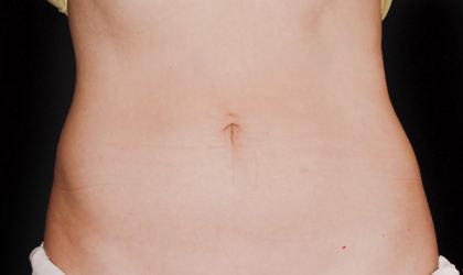 CoolSculpting Before & After Patient #1467