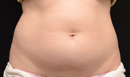 CoolSculpting Before & After Patient #1467