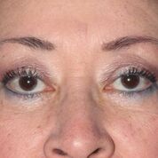 Eyelid Lift Before & After Patient #1543