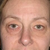 Eyelid Lift Before & After Patient #1546