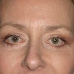 Eyelid Lift Before & After Patient #1546