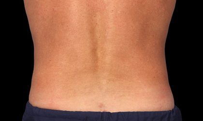 CoolSculpting Before & After Patient #1479