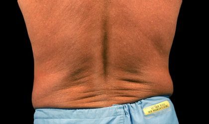 CoolSculpting Before & After Patient #1479