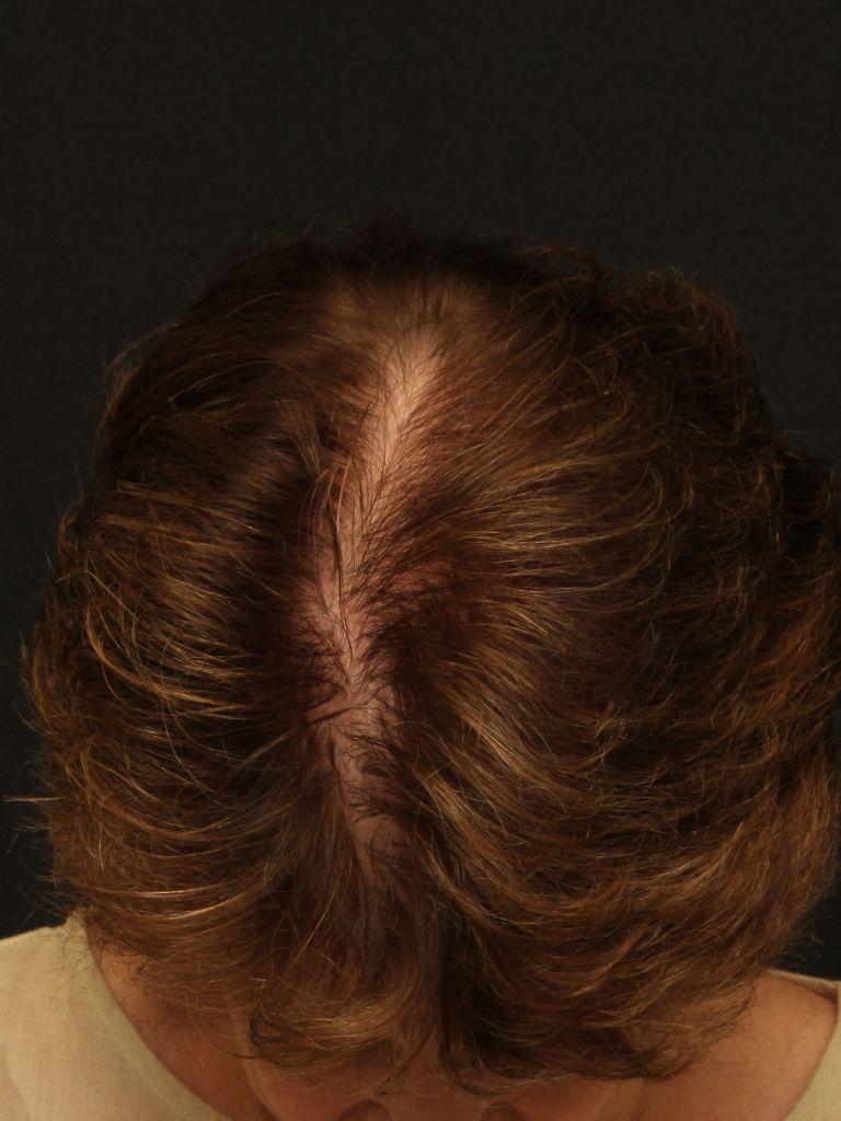 Neograft Before & After Patient #1488
